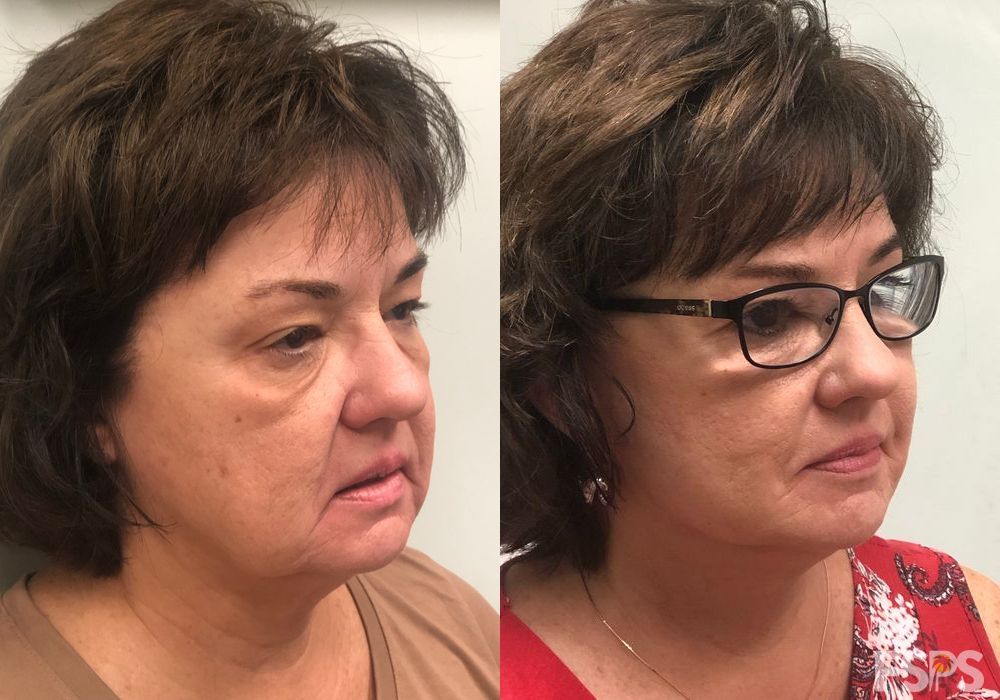 Facelift - Thumbnail 2