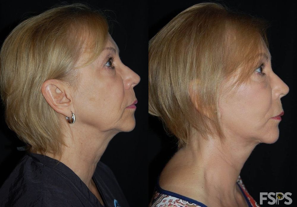 Facelift - Thumbnail 4