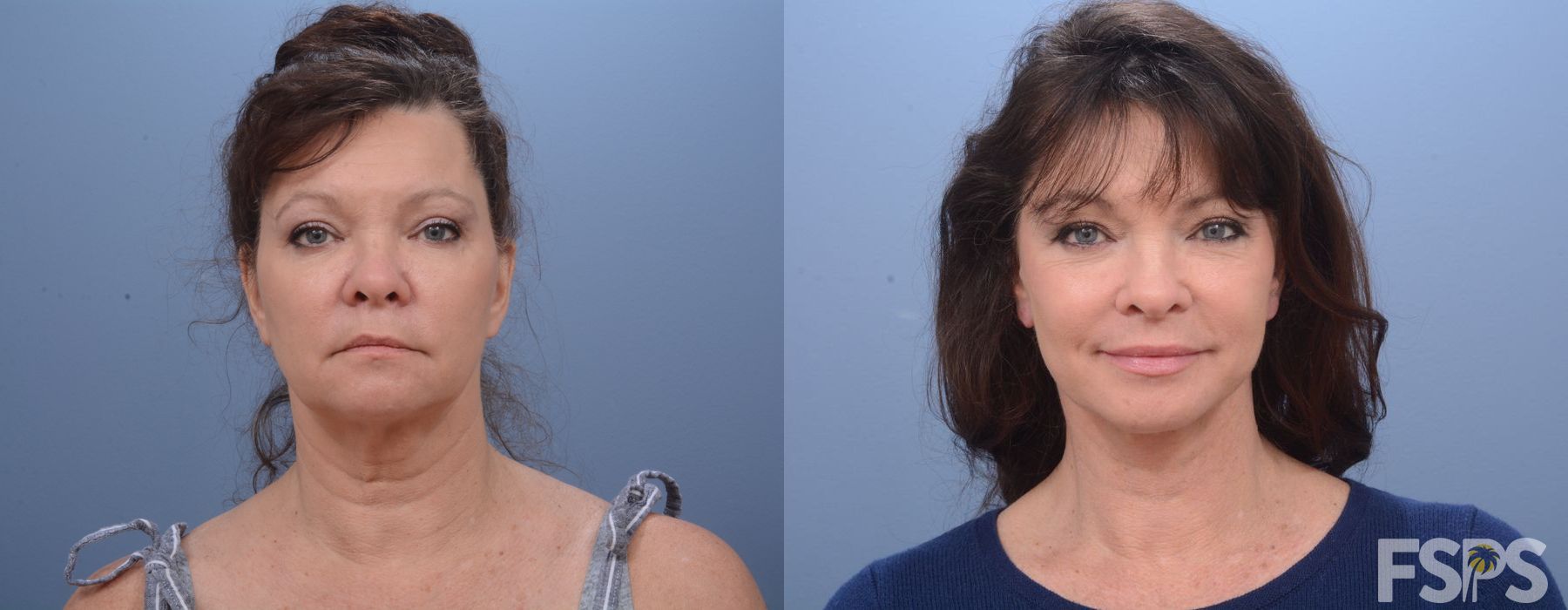 Facelift - Case 22984