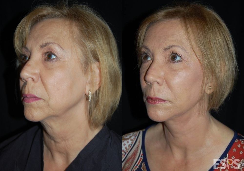 Facelift - Thumbnail 2