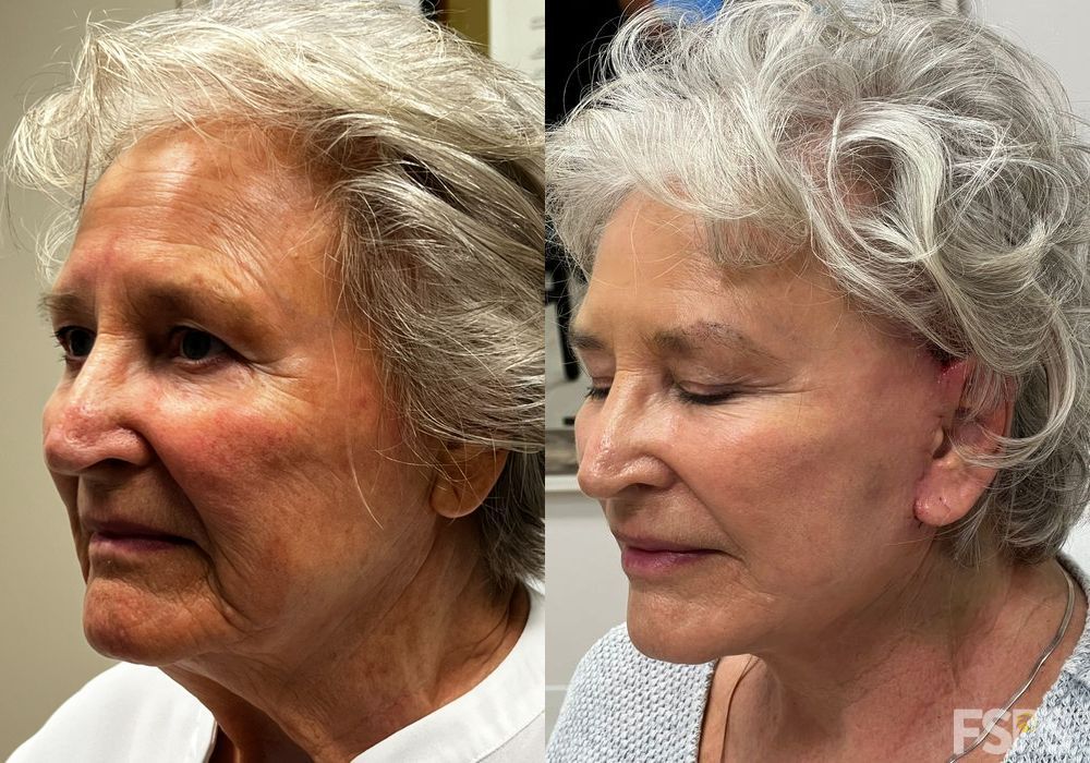 Facelift - Thumbnail 3