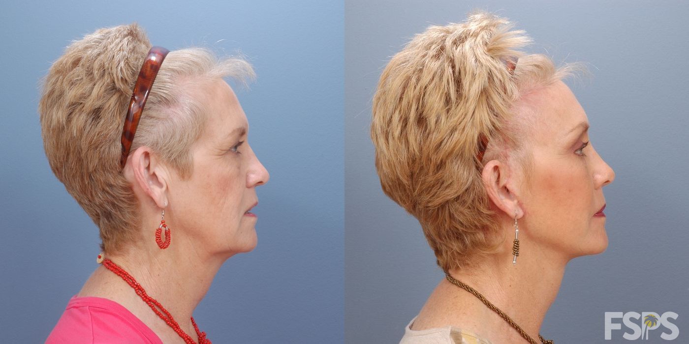 Facelift - Thumbnail 2