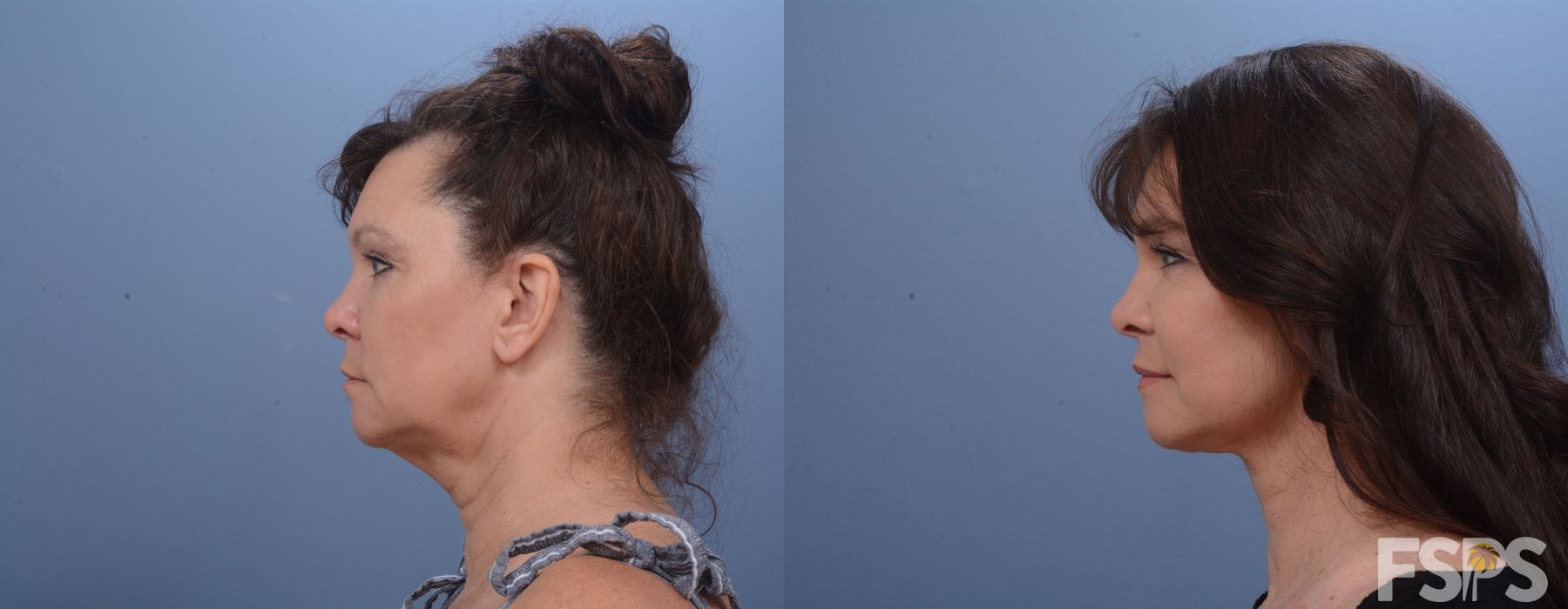 Facelift - Thumbnail 2