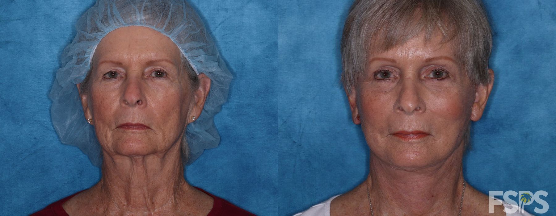 Facelift - Case 22821