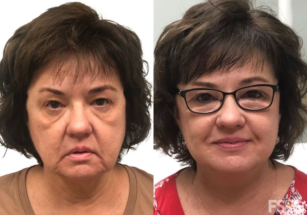 Facelift - Case 22982