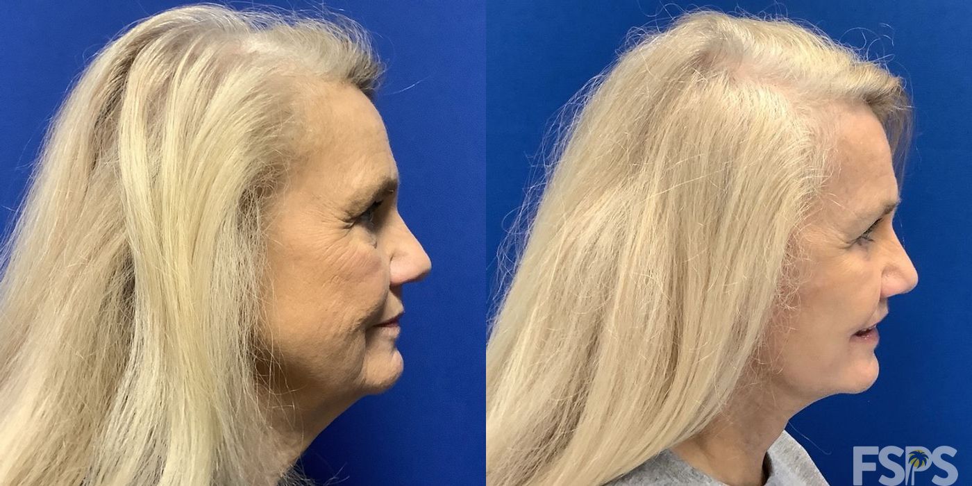 Neck Lift - Thumbnail 3