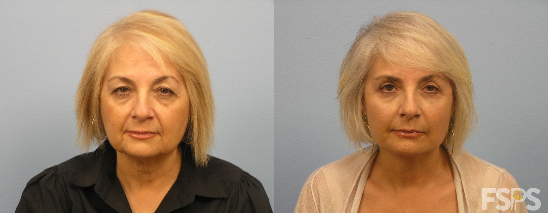 Blepharoplasty - Case 22973