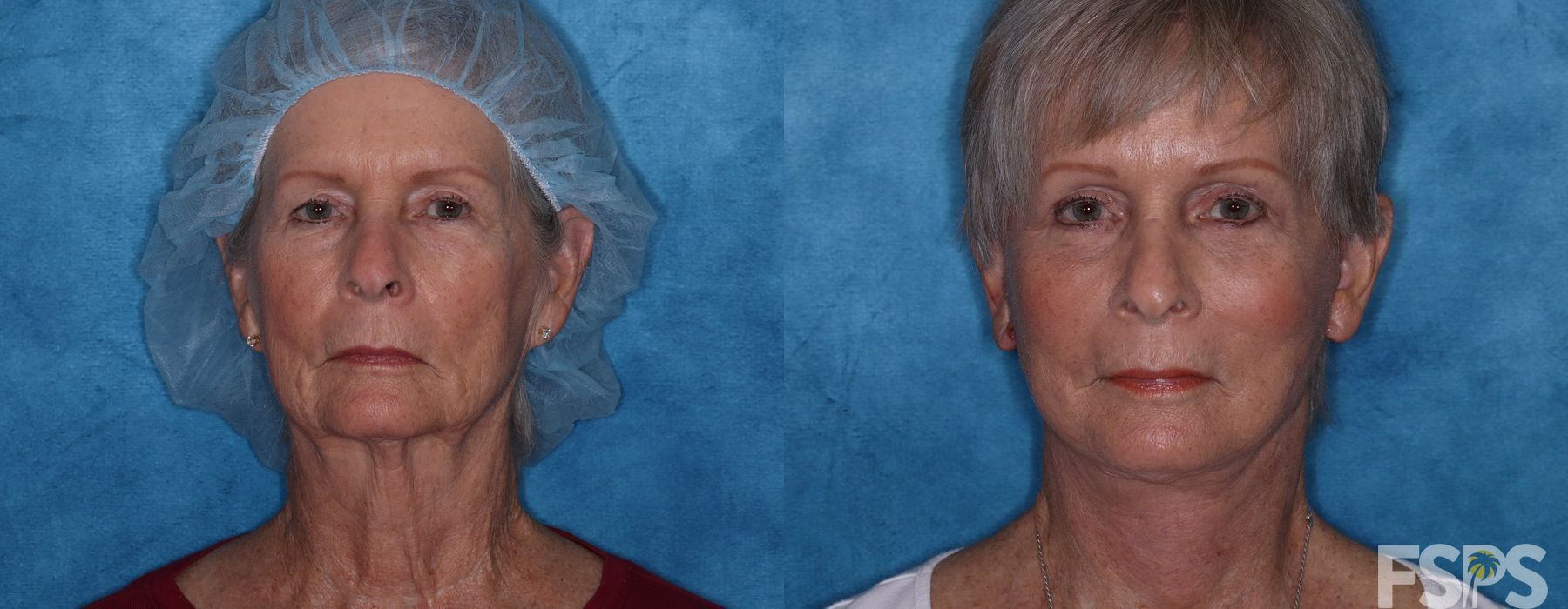 Brow Lift - Case 22817