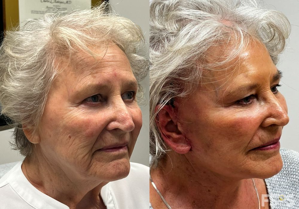 Facelift - Thumbnail 2