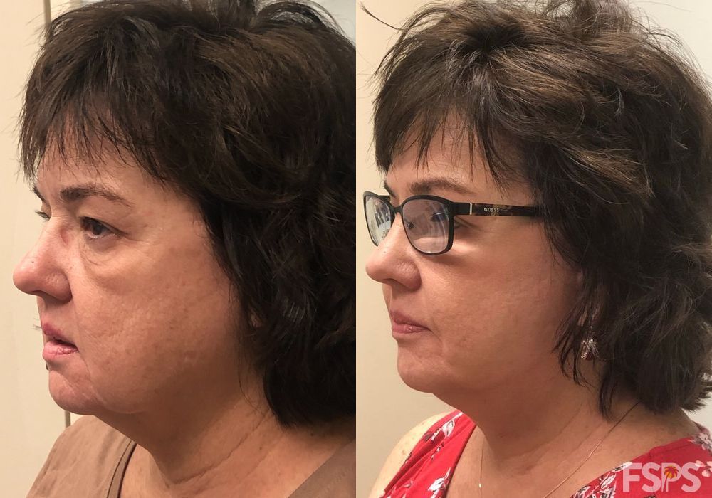 Facelift - Thumbnail 5