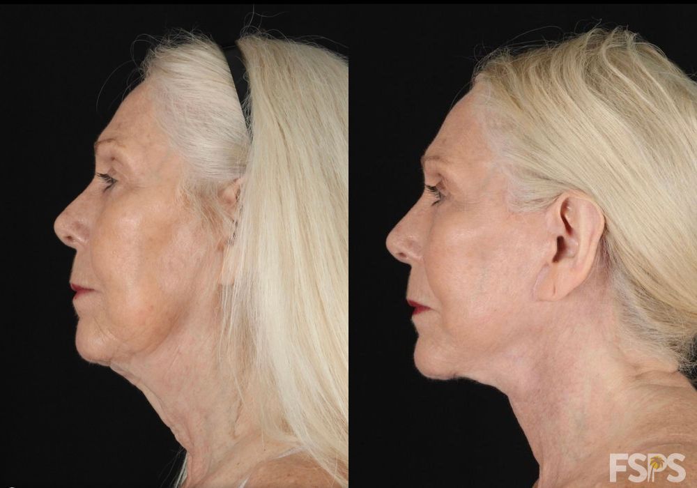 Facelift - Thumbnail 3