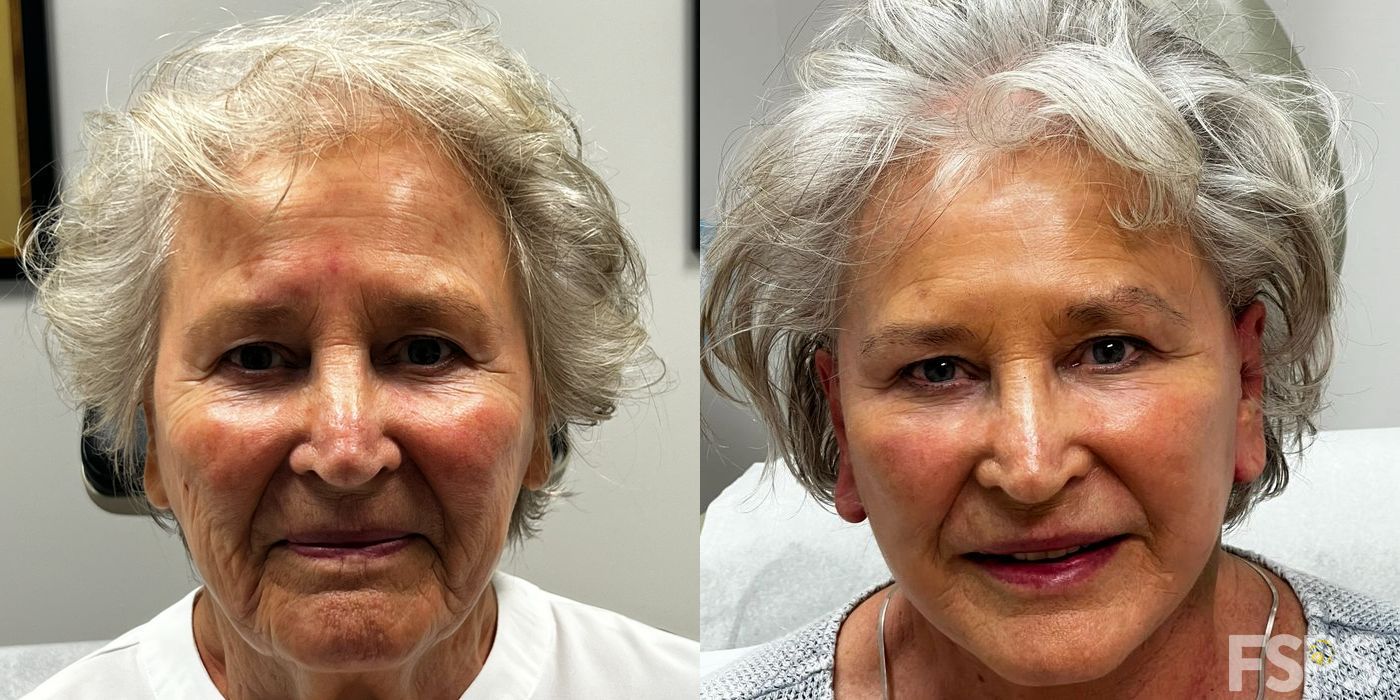 Facelift - Case 22981