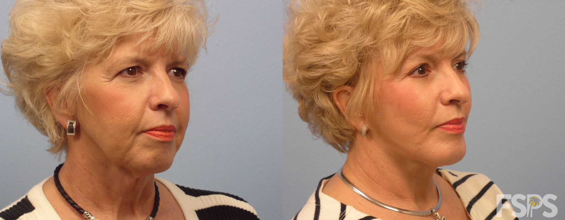 Neck Lift - Thumbnail 2