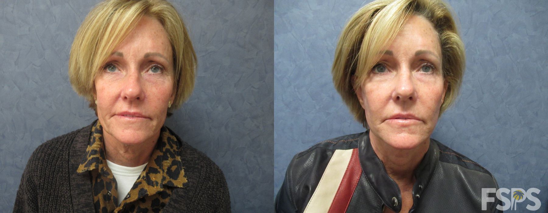 Facelift - Case 22985