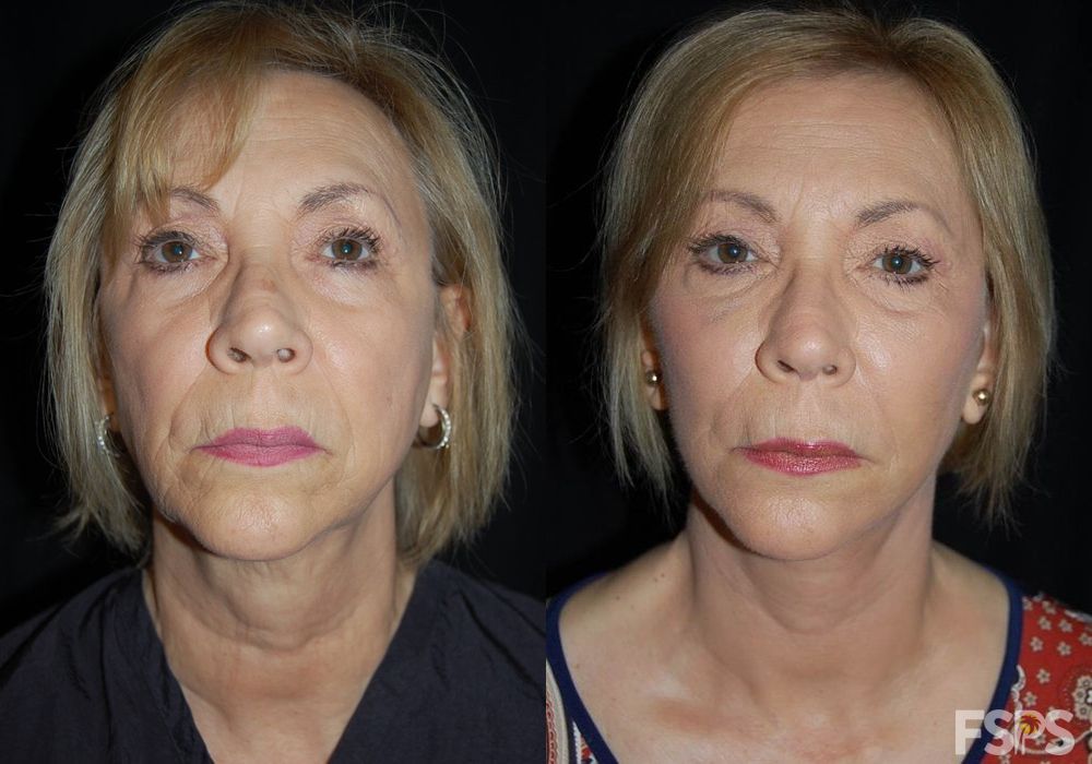 Facelift - Case 22822