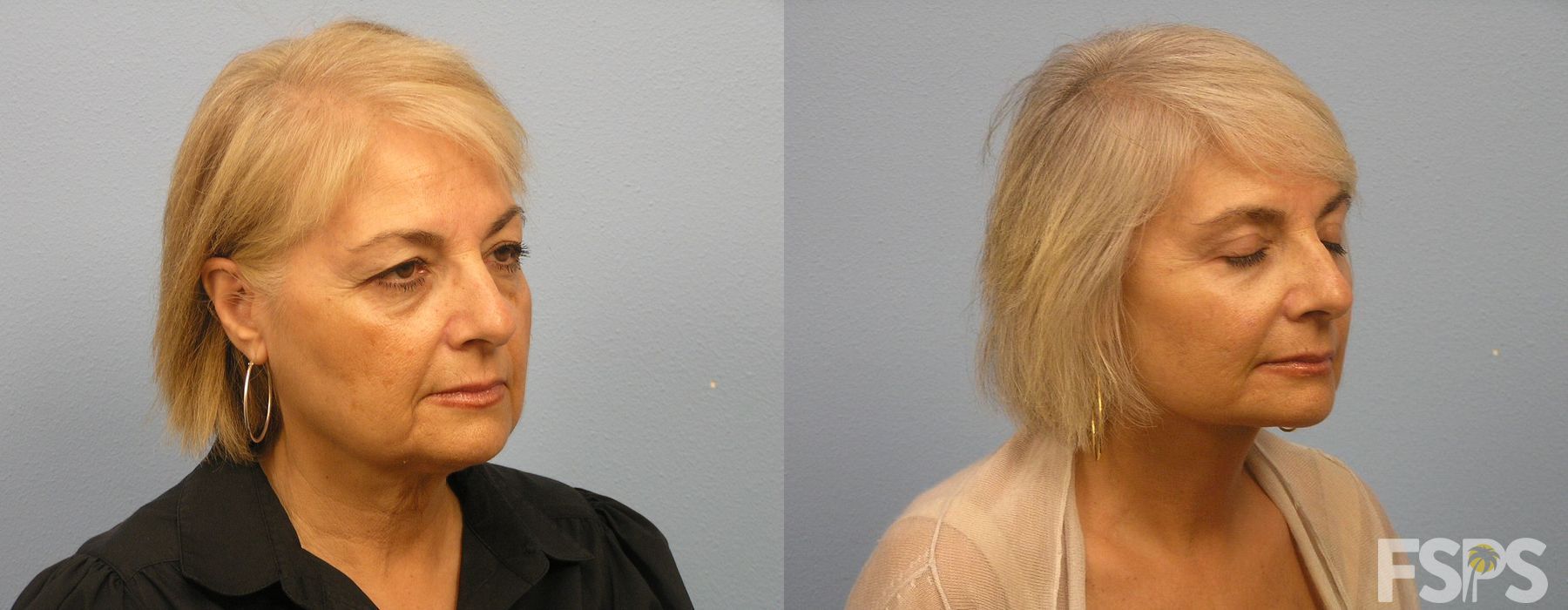 Blepharoplasty - Thumbnail 2