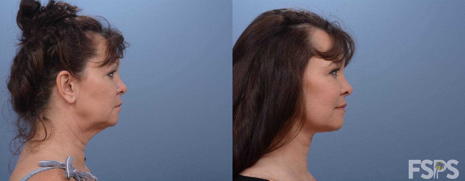 Facelift - Thumbnail 3