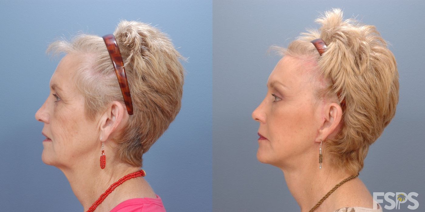 Facelift - Thumbnail 3