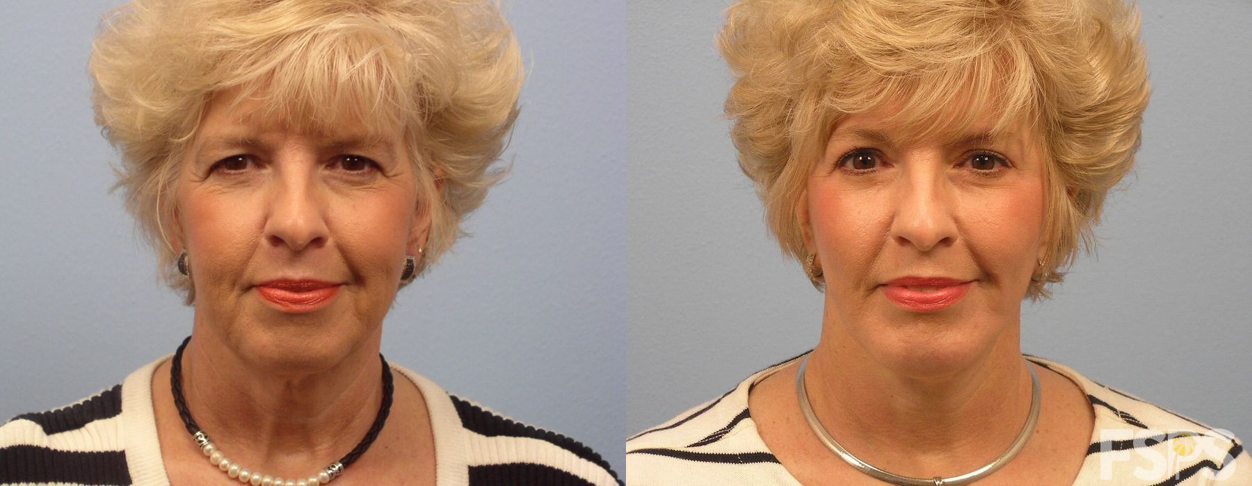 Neck Lift - Case 22998