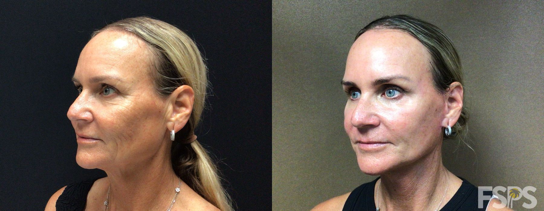 Before photo - Angle 2