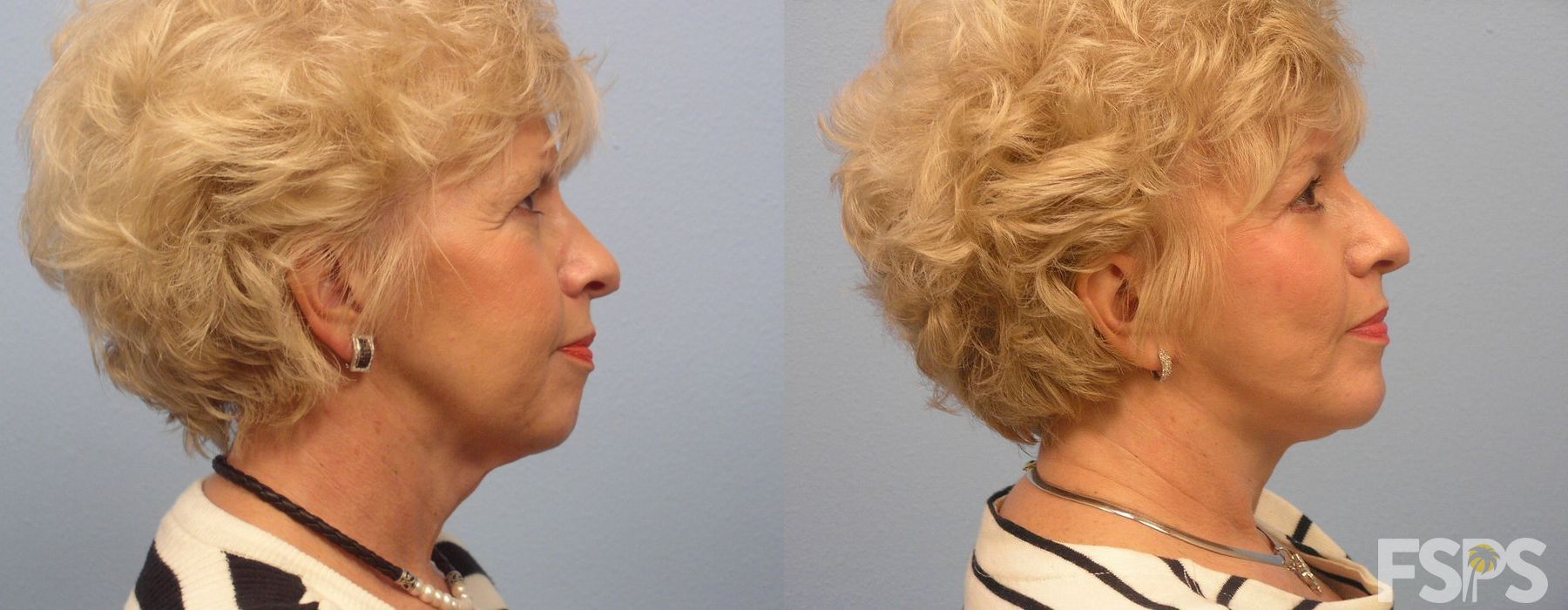 Neck Lift - Thumbnail 3