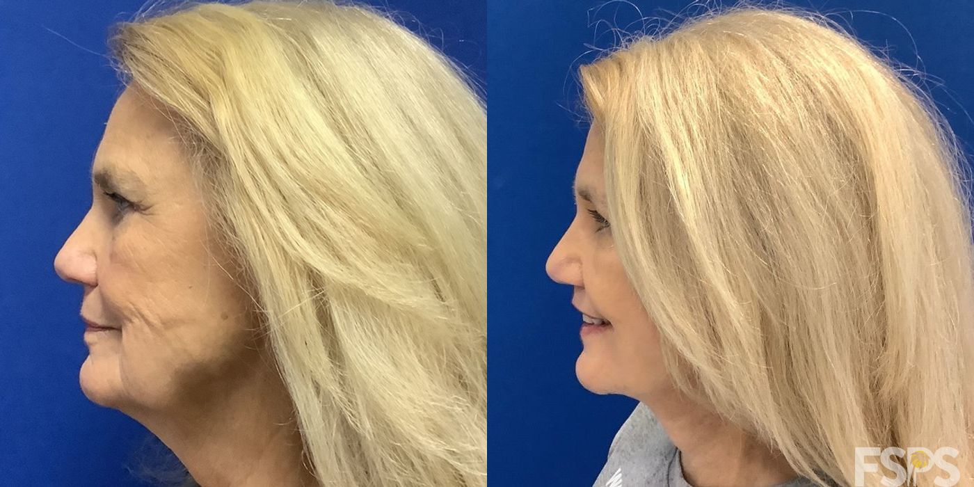 Neck Lift - Thumbnail 4