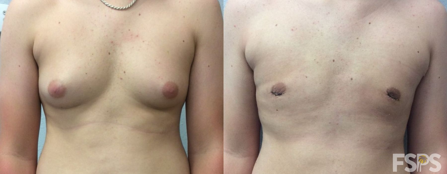 Gynecomastia - Case 22808