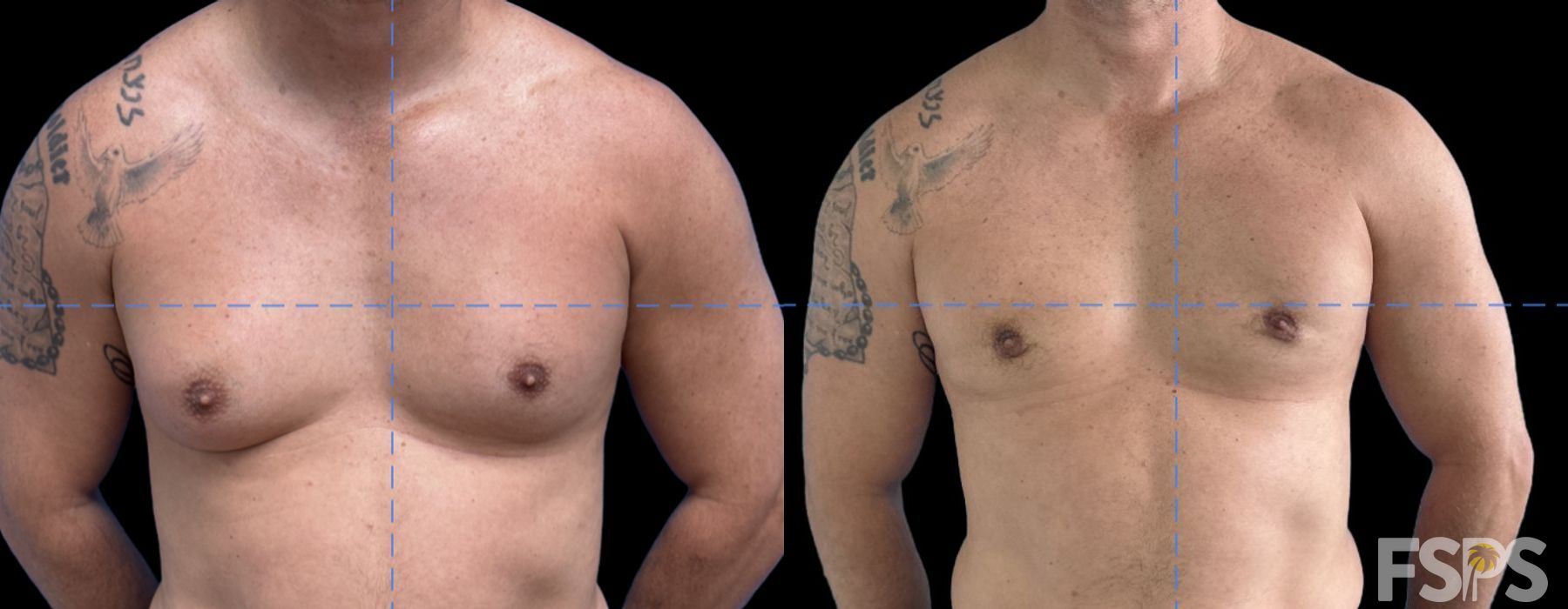 Gynecomastia - Case 22968