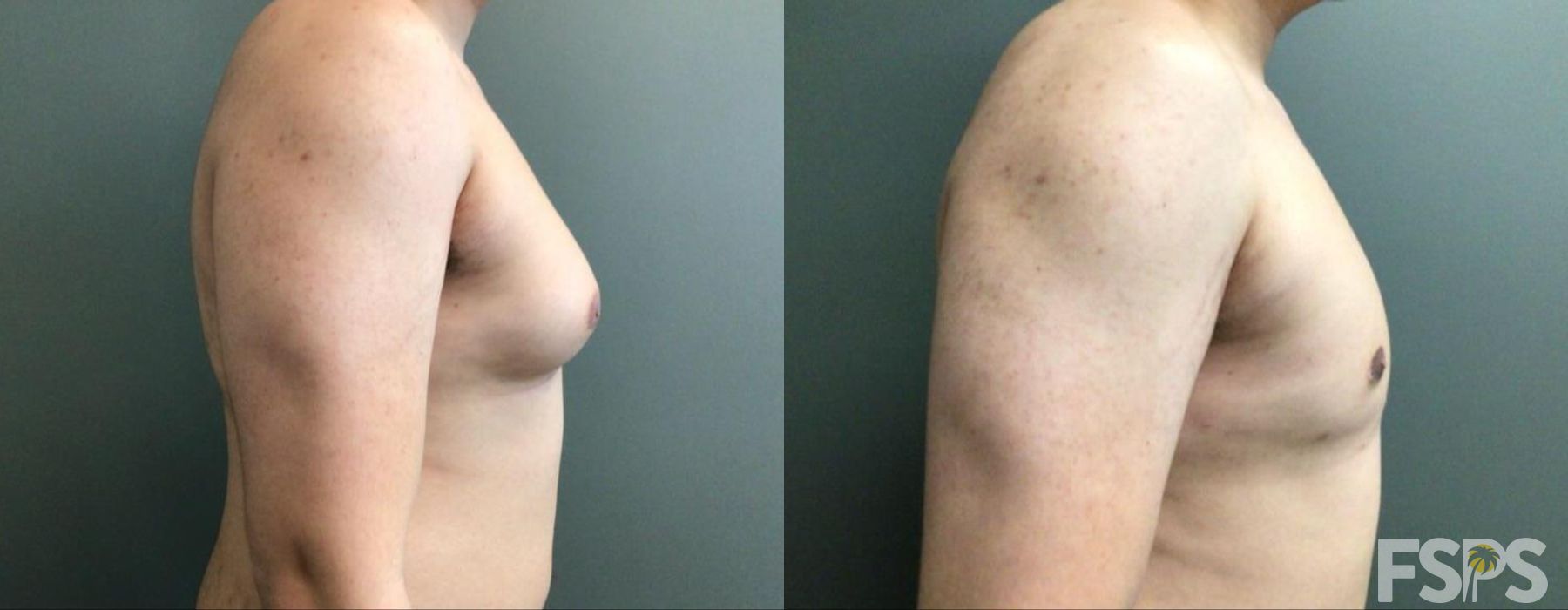 Gynecomastia - Thumbnail 2