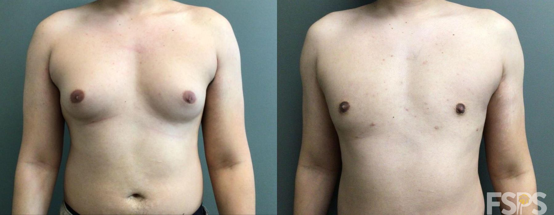 Gynecomastia - Case 22680