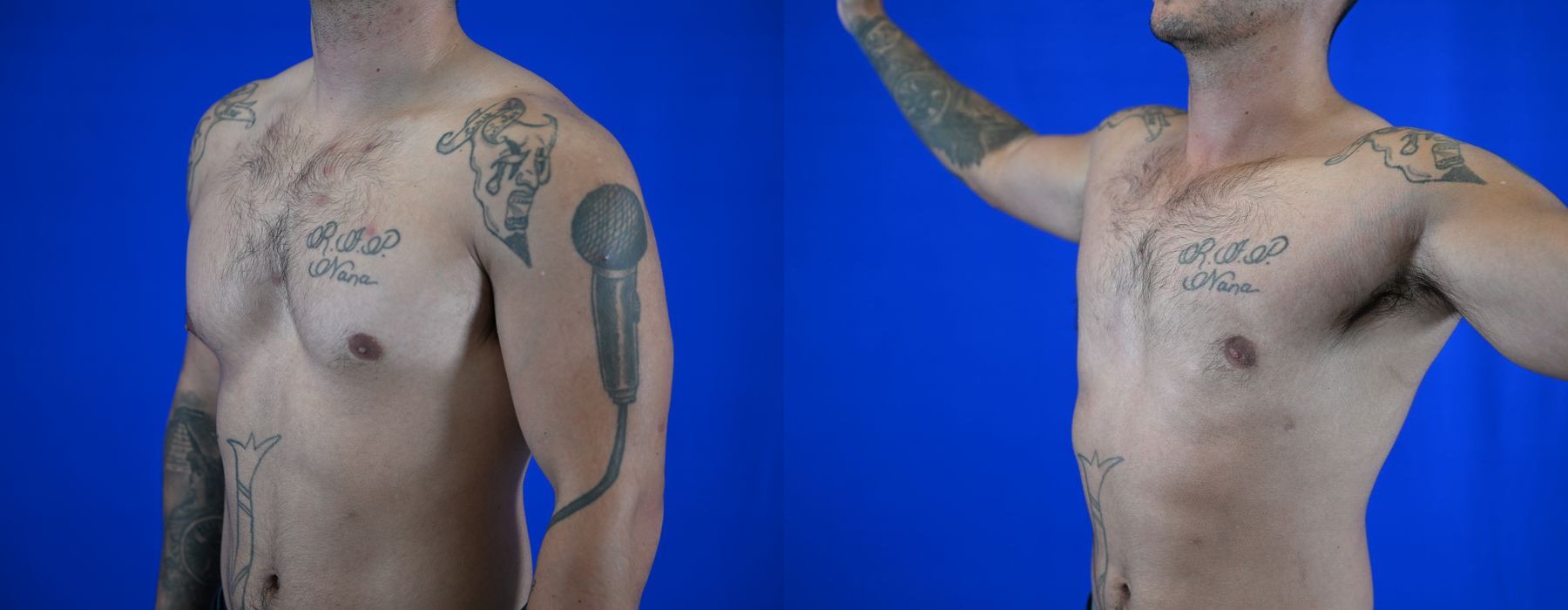 Gynecomastia - Thumbnail 2