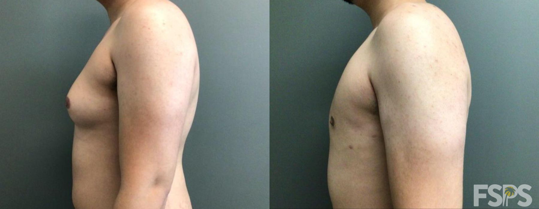 Gynecomastia - Thumbnail 3