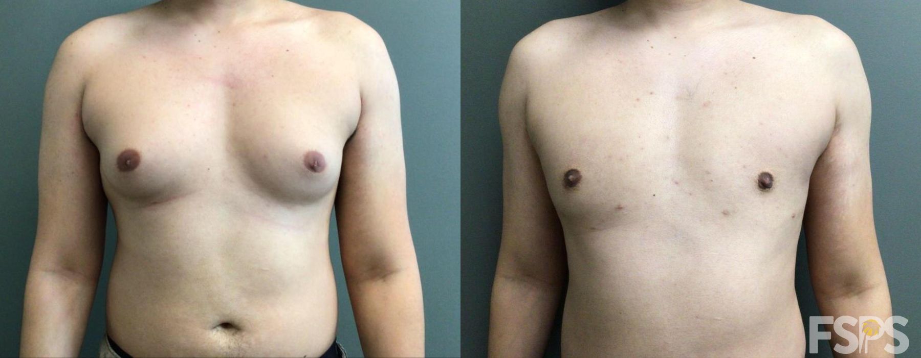 Gynecomastia - Case 22809