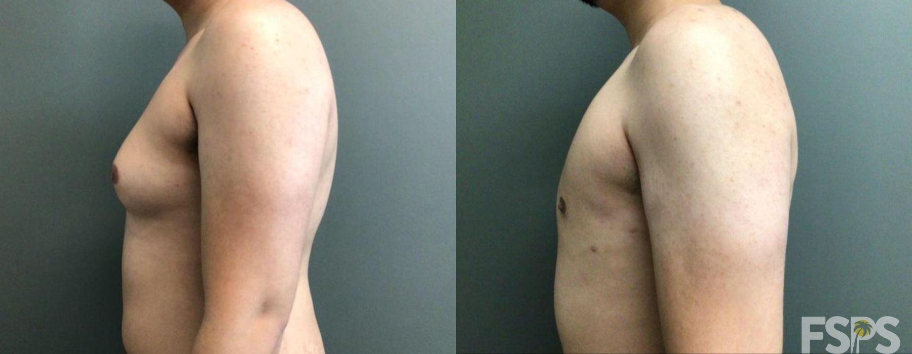 Gynecomastia - Thumbnail 3