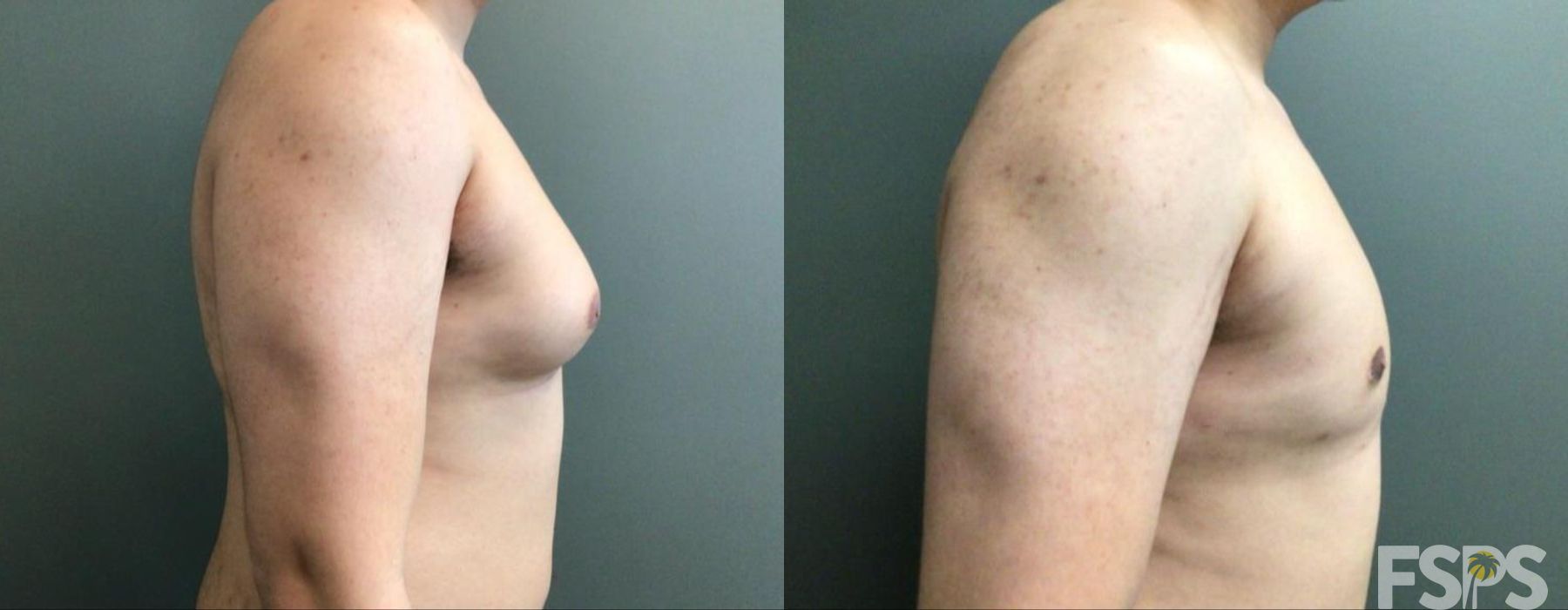 Gynecomastia - Thumbnail 2