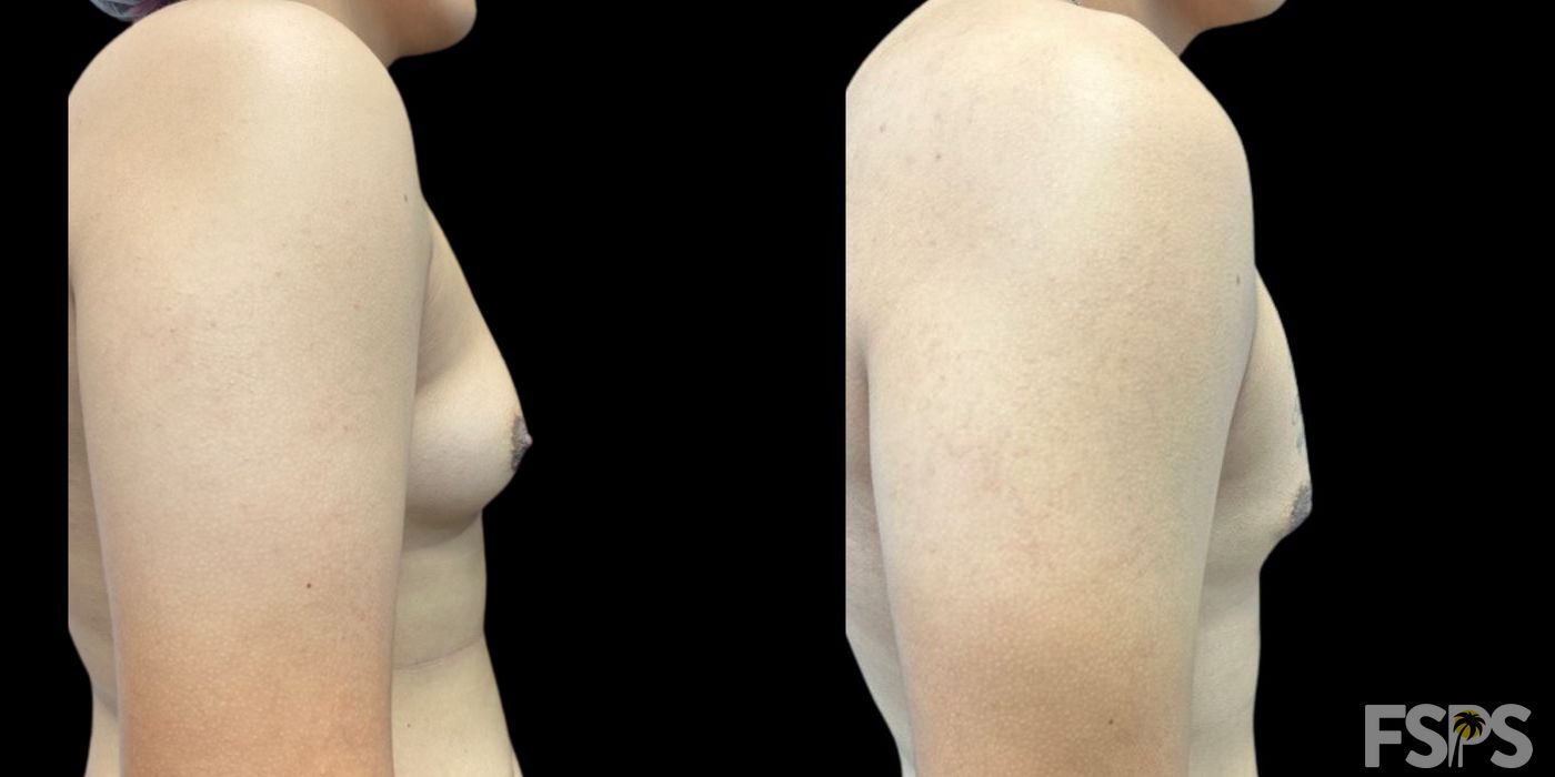 Gynecomastia - Thumbnail 2