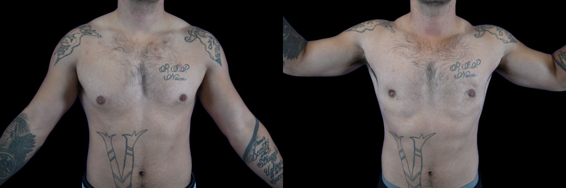 Before and after Liposuction case 26082