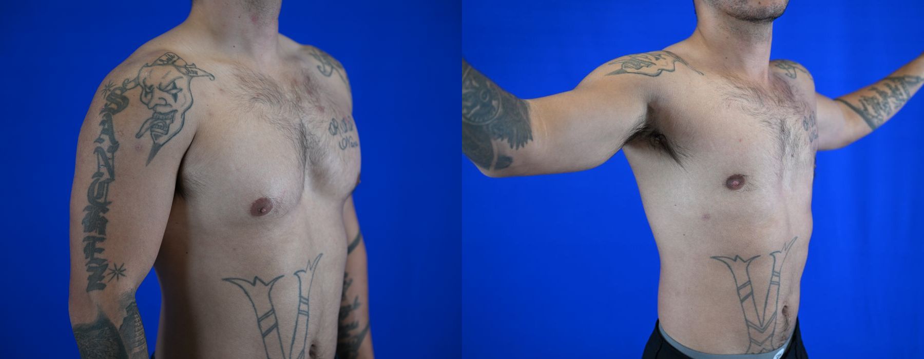 Before and after Liposuction case 26082 - Angle 3