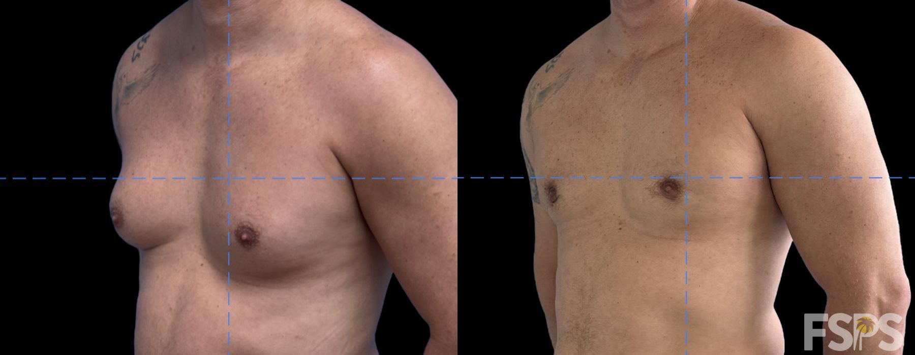 Gynecomastia - Thumbnail 2