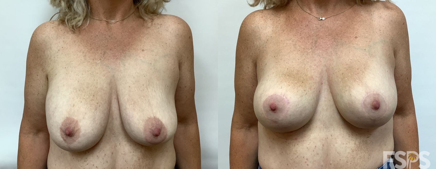 Implant Exchange - Thumbnail 2