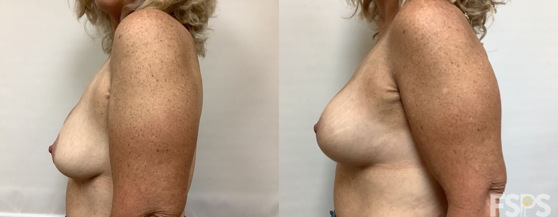 Implant Exchange - Case 22811