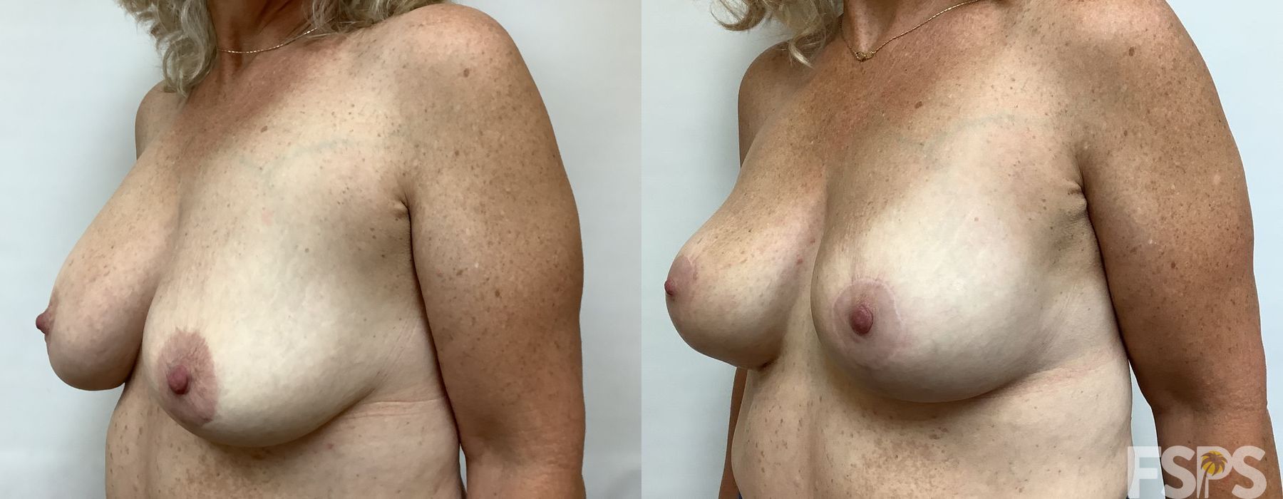 Implant Exchange - Thumbnail 3