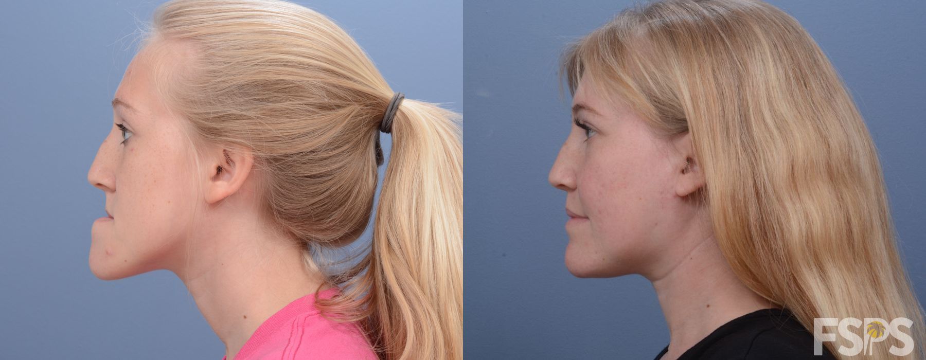 LeFort I Maxillary Advancement - Thumbnail 3