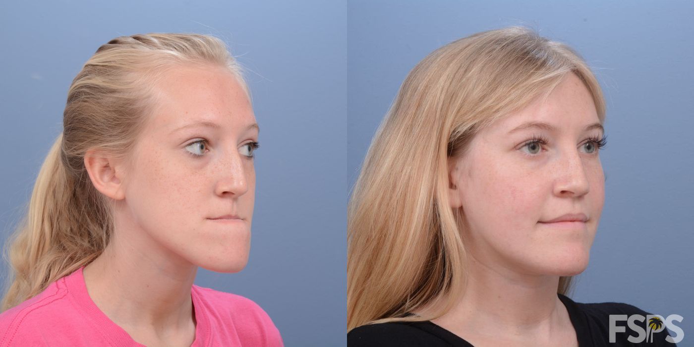 LeFort I Maxillary Advancement - Thumbnail 4