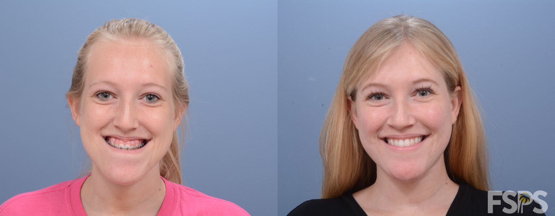 LeFort I Maxillary Advancement - Thumbnail 6