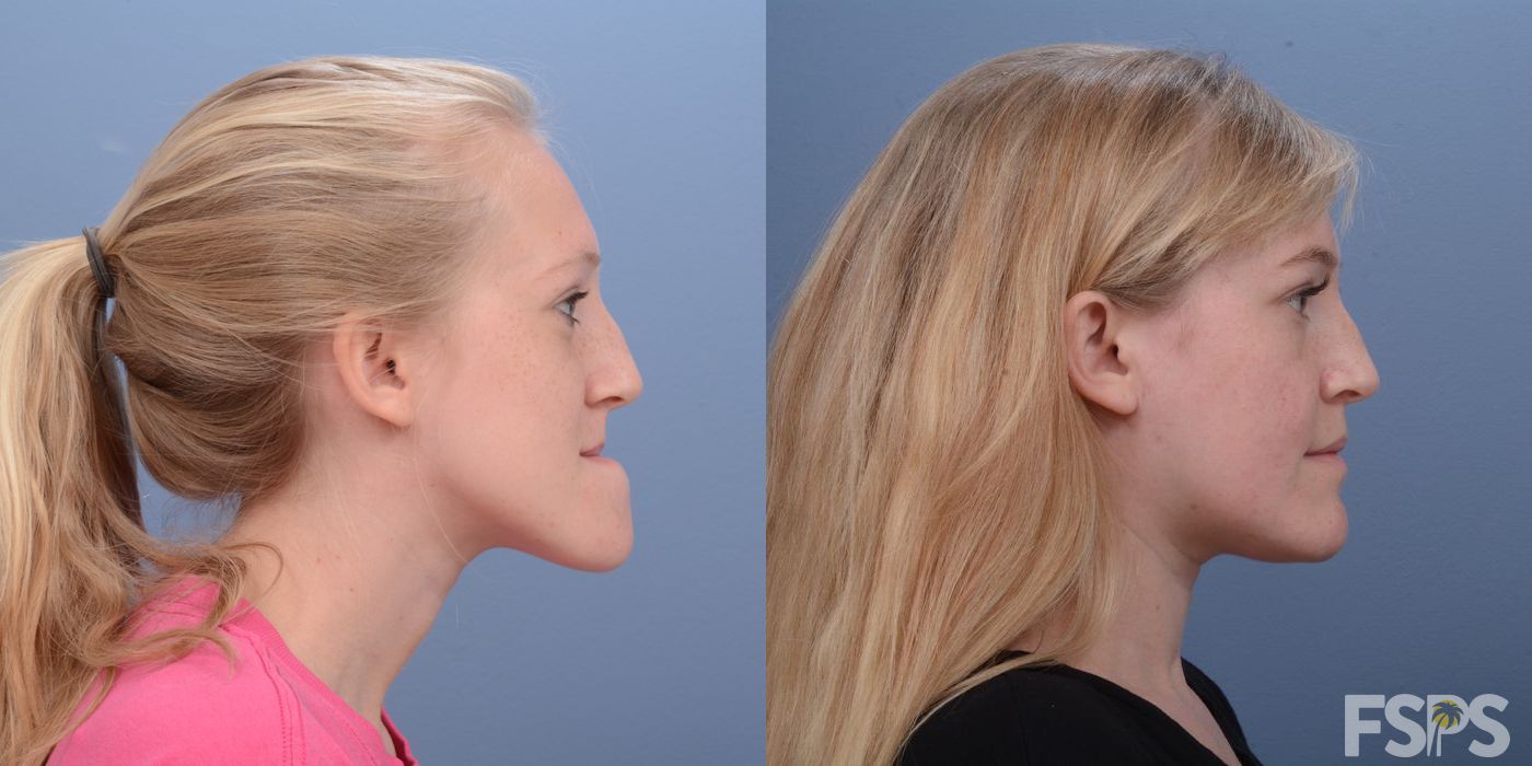 LeFort I Maxillary Advancement - Thumbnail 2