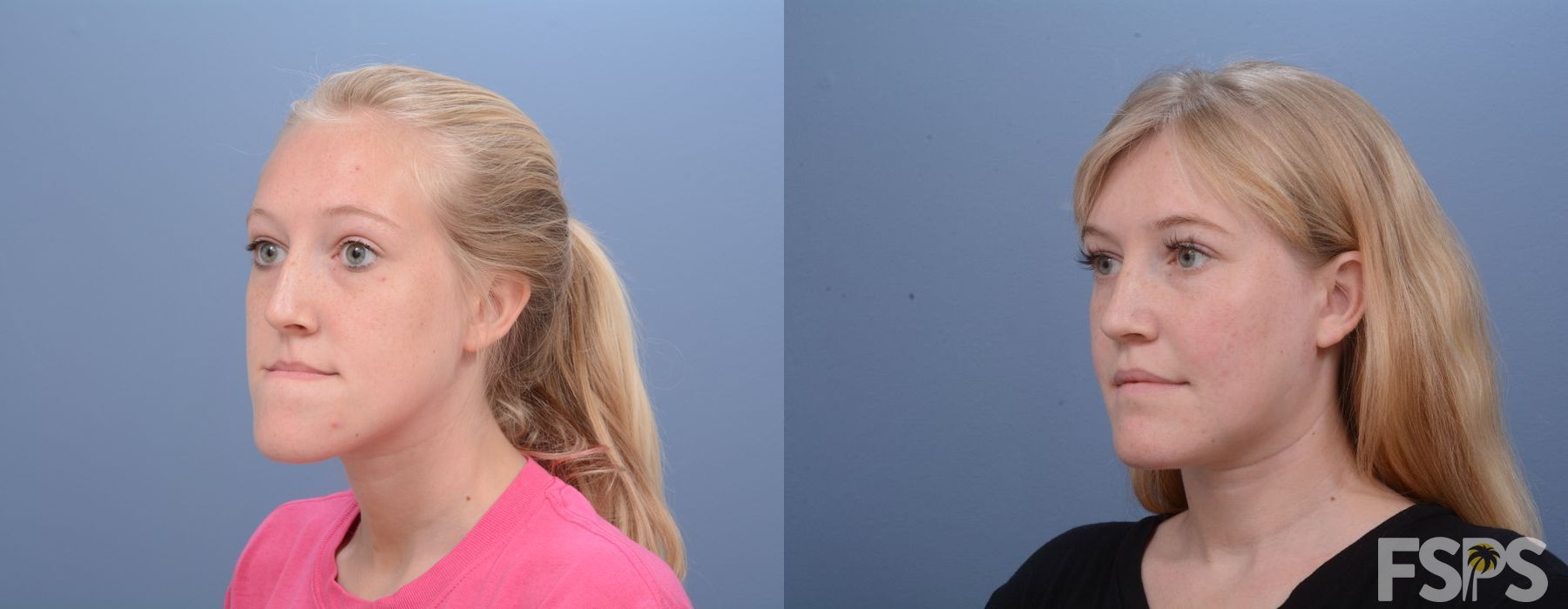 LeFort I Maxillary Advancement - Thumbnail 5