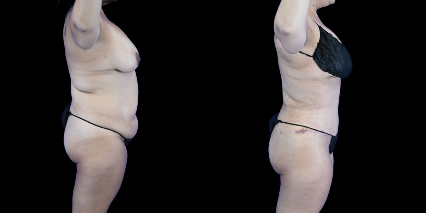 Before and after Liposuction case 26084 - Angle 6