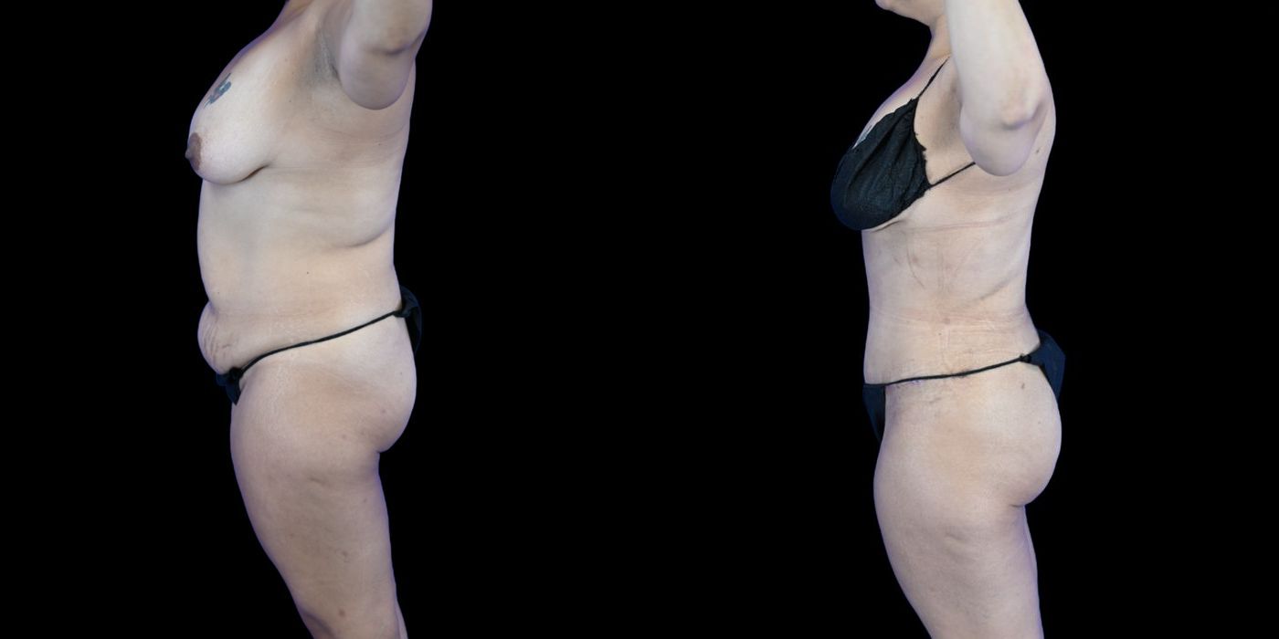 Before and after Liposuction case 26084 - Angle 3