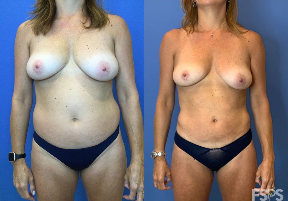 Liposuction - Thumbnail 3